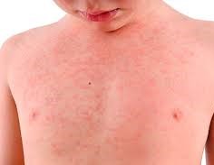 दादुराका ६७ बिरामी उपचारपछि घर फर्के, २० जनाको ‘आइसोलेसन’ उपचार जारी